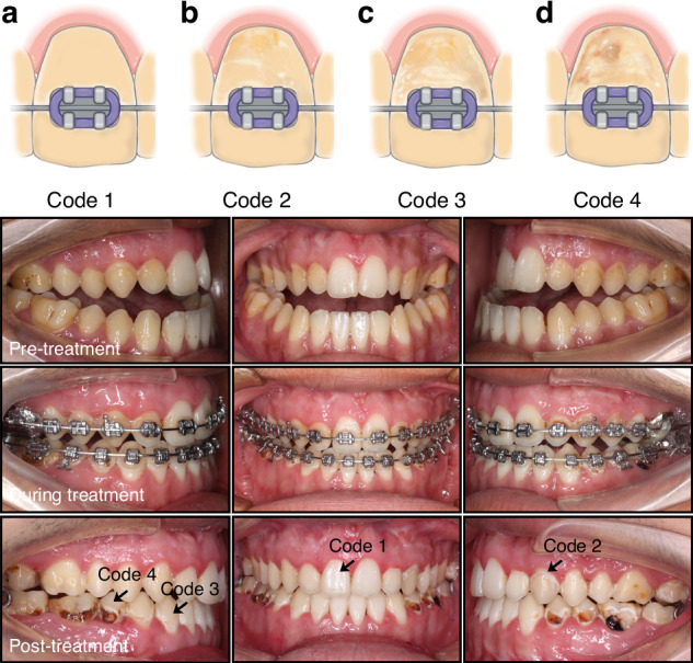 the method used for lesion scoring and the intraoral photographs of the appearance of WSLs in the progress of orthodontic treatment
