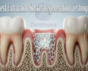 Latest Extraction Socket Regeneration Techniques