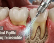 Stem Cells from Apical Papilla in Treating Periodontitis