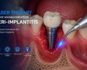Laser Therapy in the Management of Peri-Implantitis