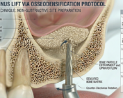 Latest Sinus Lifting Techniques in Modern Implant Dentistry