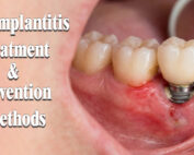 Peri-Implantitis Treatment & Prevention Methods
