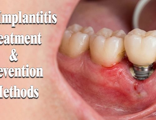 Peri-Implantitis Treatment & Prevention Methods