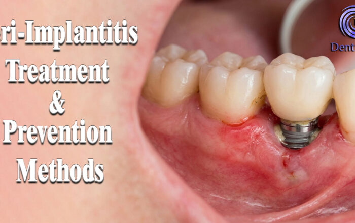 Peri-Implantitis Treatment & Prevention Methods