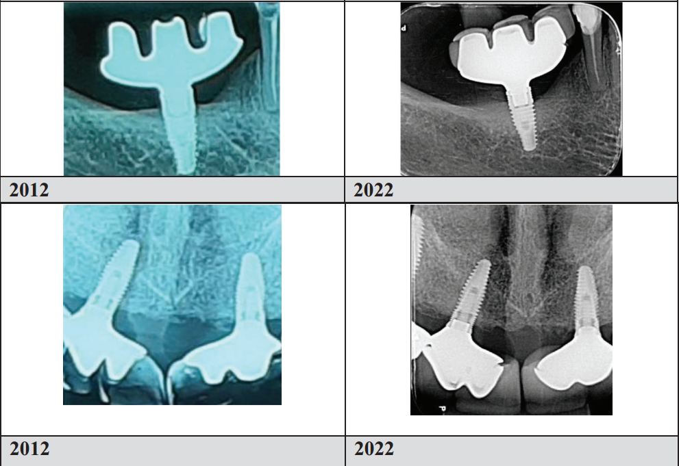 Triple Abutment 10 year follow up by Dr. Luciana and her team