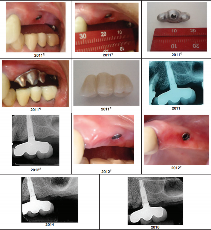 Triple Abutment 7 year follow up by Dr. Luciana and her team