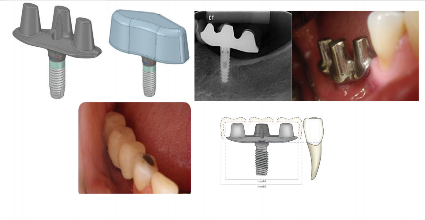 TA Triple Abutment Concept by Dr. Luciana