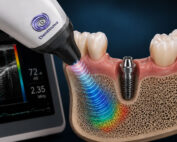 The Use of Ultrasound in Modern Implant Dentistry